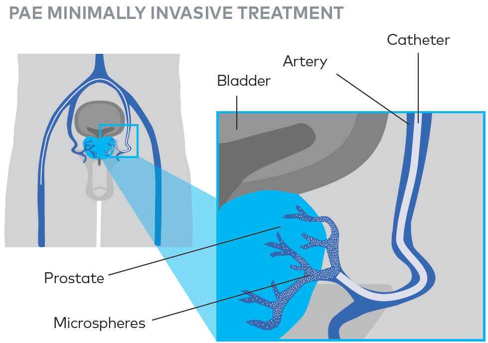 pae minimally invasive diagram