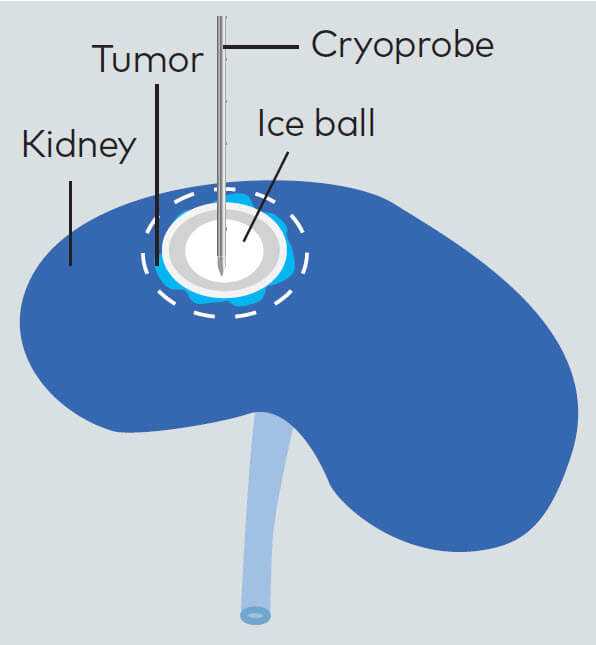 renal cryo diagram