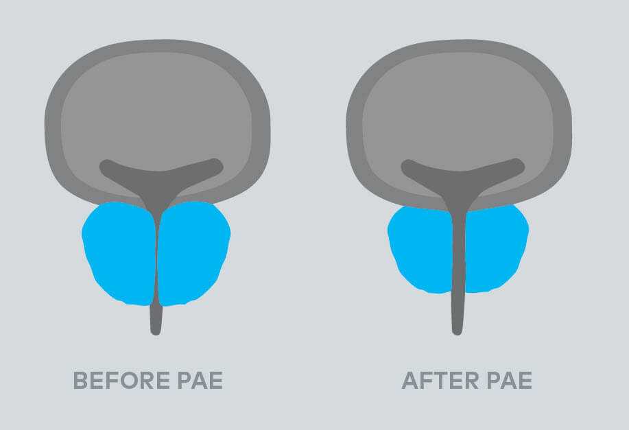 pae before after diagram